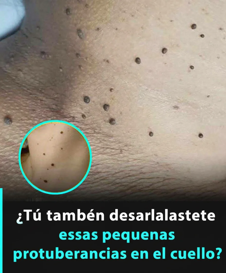 Desvelando los Acrocordones: Seis Razones Comunes para la Aparición de 'Skin Tags', Según Expertos