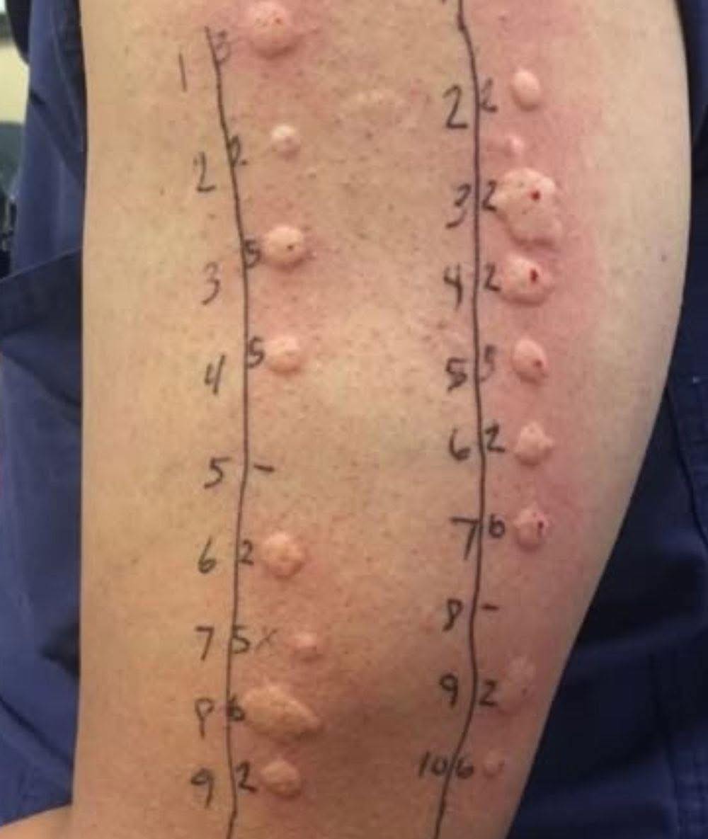 ¿Amaneciste con esto en tu piel? Qué podría ser y cuándo debes preocuparte