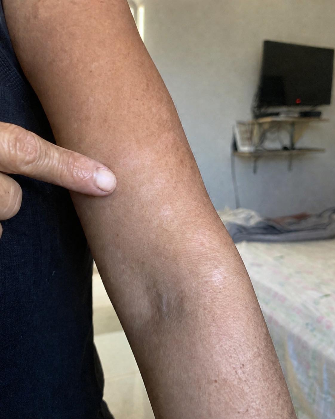 ¿Qué se esconde tras las manchas blancas en la piel? Descubre las posibles causas