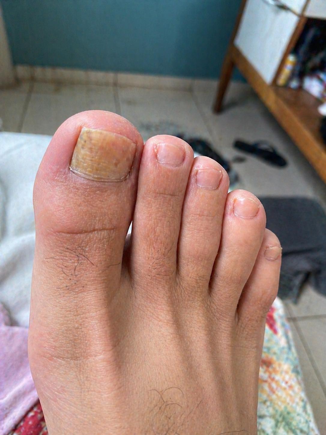 Di adiós a los hongos en las uñas con este sencillo remedio natural