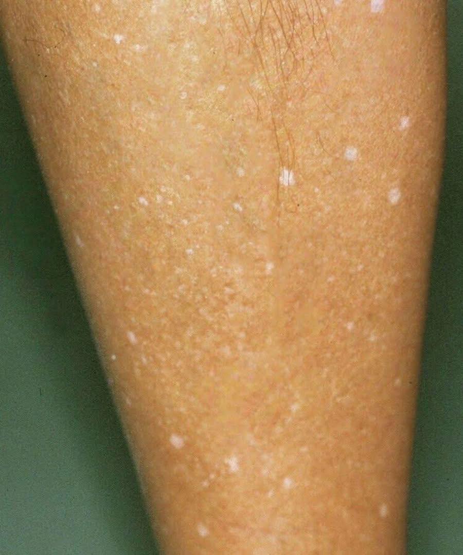 ¿Qué puede haber detrás de las manchas blancas en la piel? Conozca las posibles causas