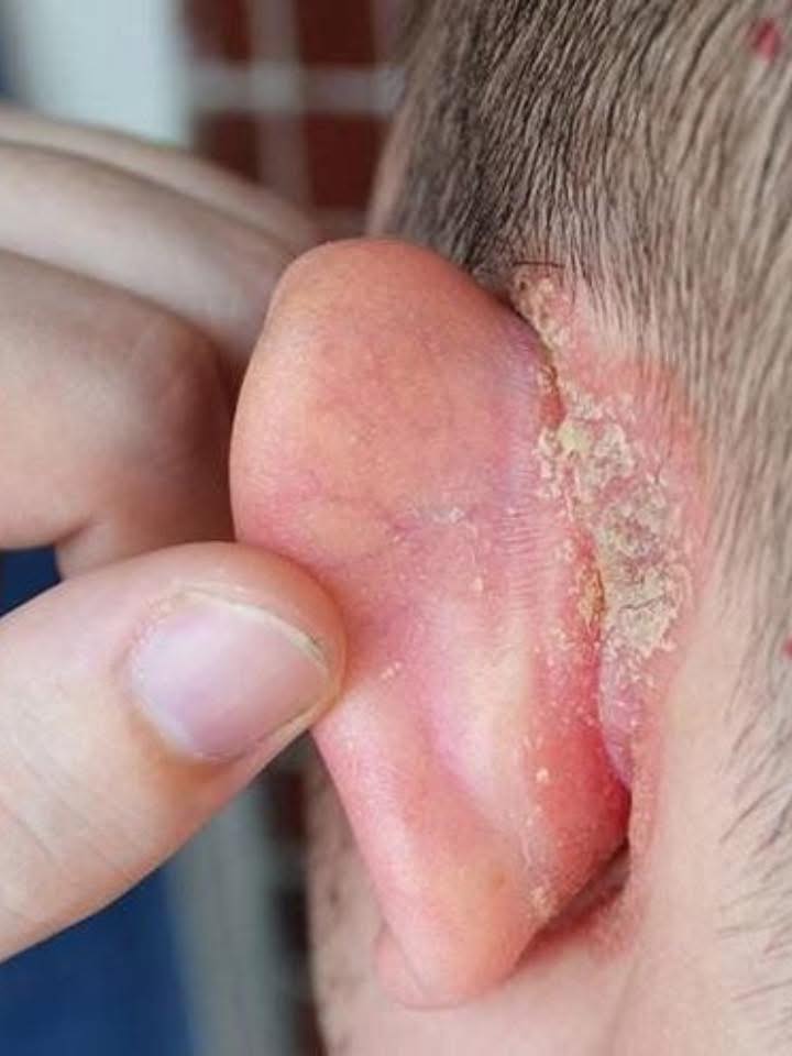 Mi hijo amaneció con una mancha en la oreja: ¿qué podría ser y cómo cuidarlo hasta la consulta?