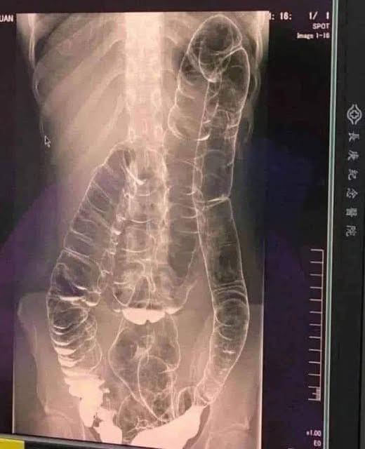 Colon sobrecargado: las señales de alerta de tu cuerpo
