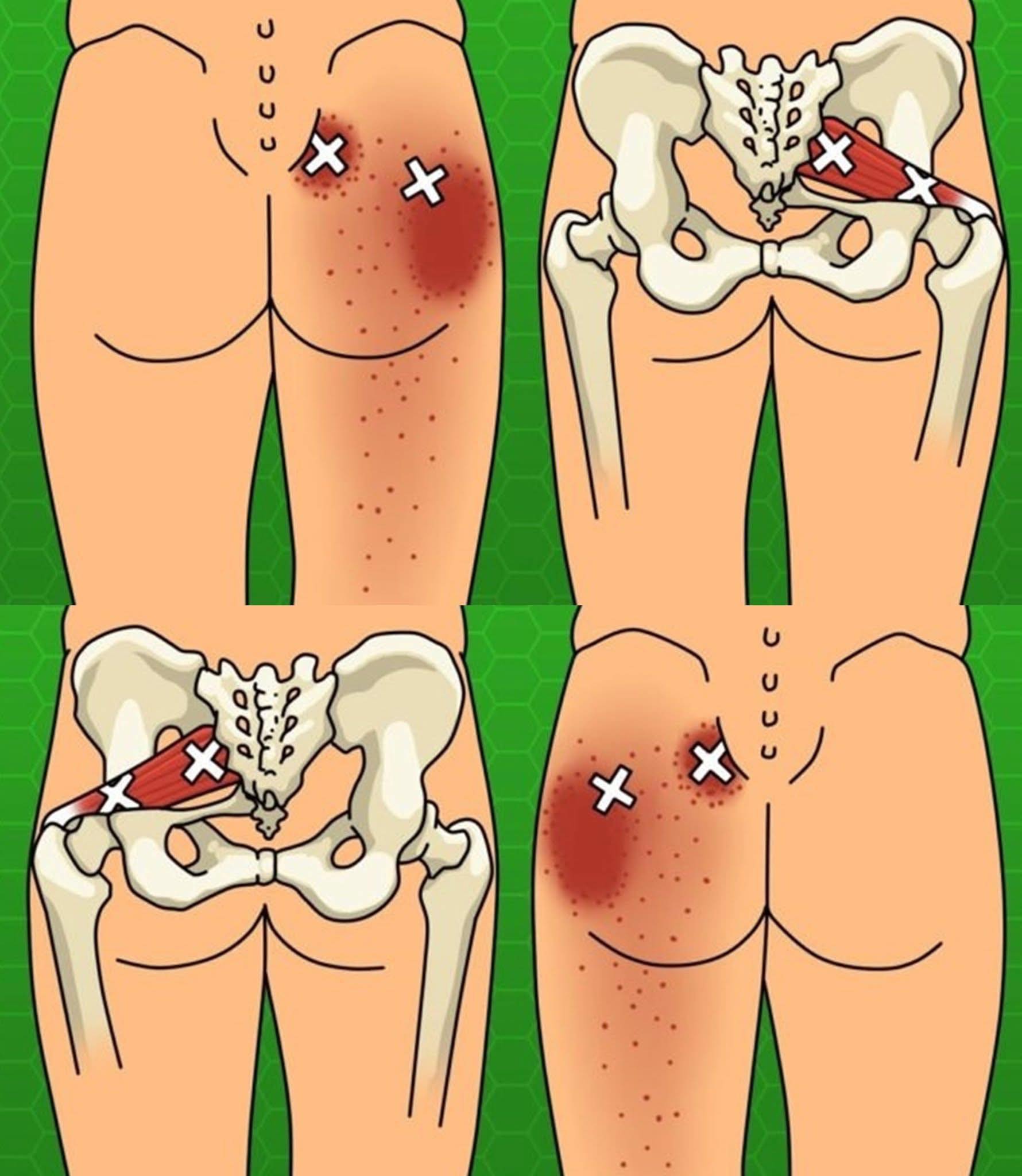 ¿Conoces estas soluciones naturales para aliviar la ciática y el dolor lumbar?