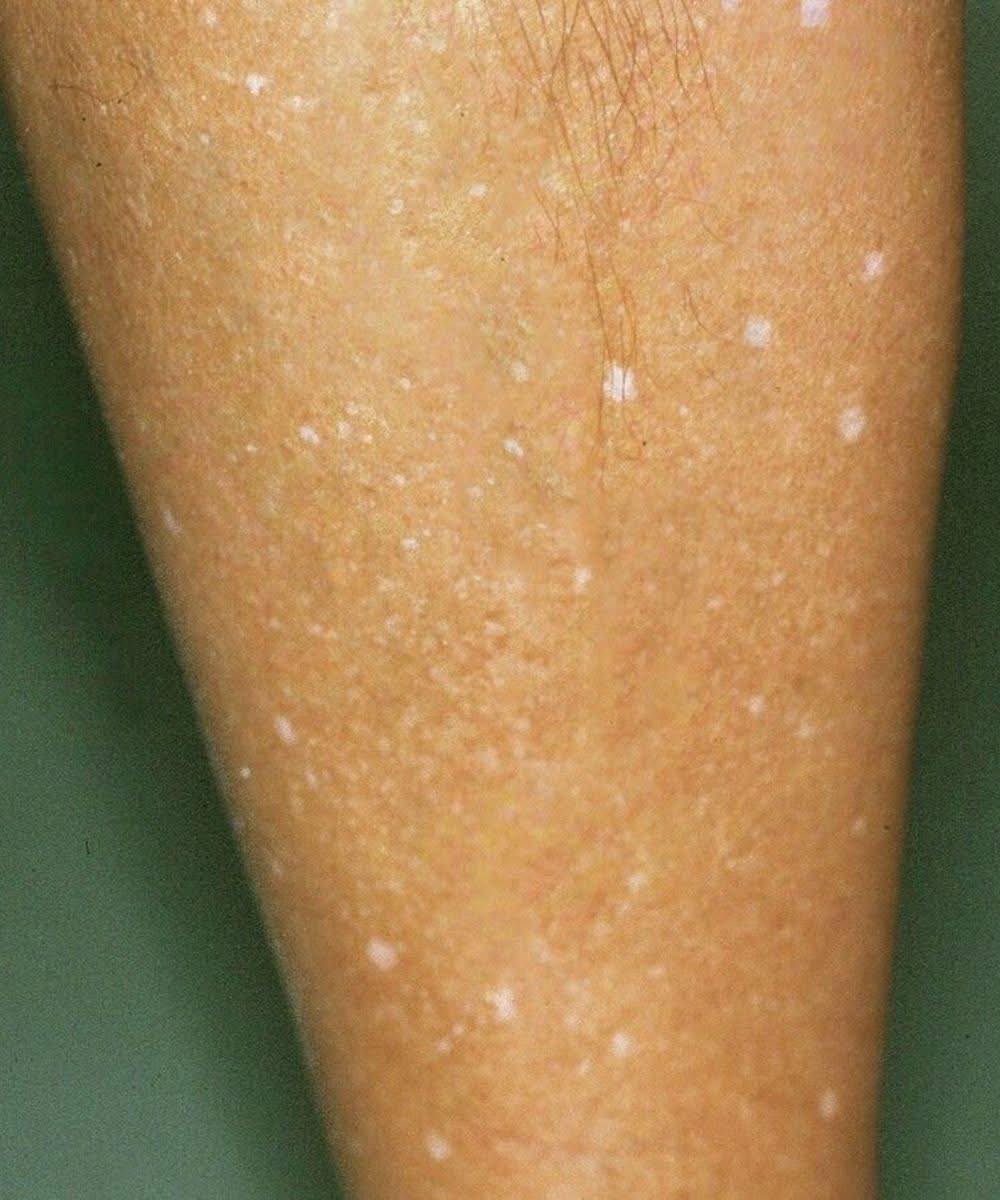 ¿Qué hay detrás de las manchas blancas en la piel? Conoce sus posibles causas